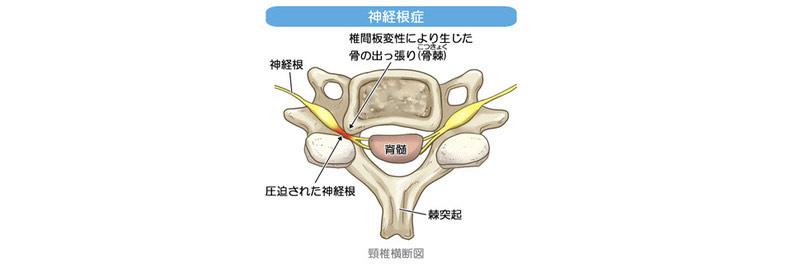 ヘルニア